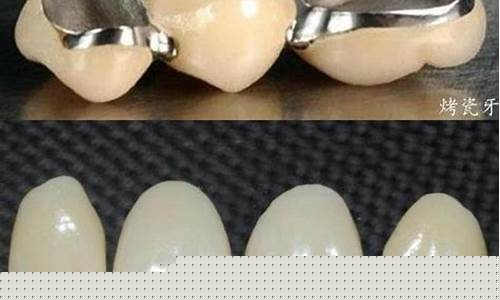 钯银烤瓷合金价格_钯银合金烤瓷牙和全瓷牙